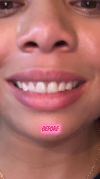 Video review of MySmile Non-Sensitive Teeth Whitening Pen Mint Gel Enamel Safety 8ML 30+ Whitening Treatments Fast Remove 20 Years of Stains Whitening Tooth Care Oral Bright Smile Alternative Teeth Whitening Strips  by 67bfc215a2dda36227dbab09