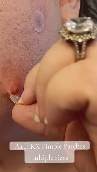 Video review of Patch RX Spot Patch  by info203456